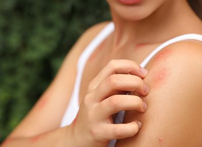 mosquito bites on shreveport resident