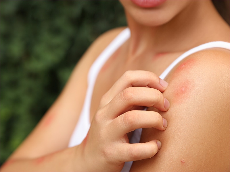 mosquito bites on shreveport resident