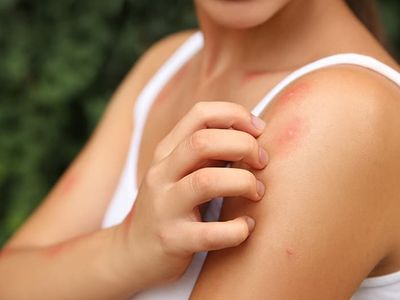 albuquerque resident itching mosquito bites