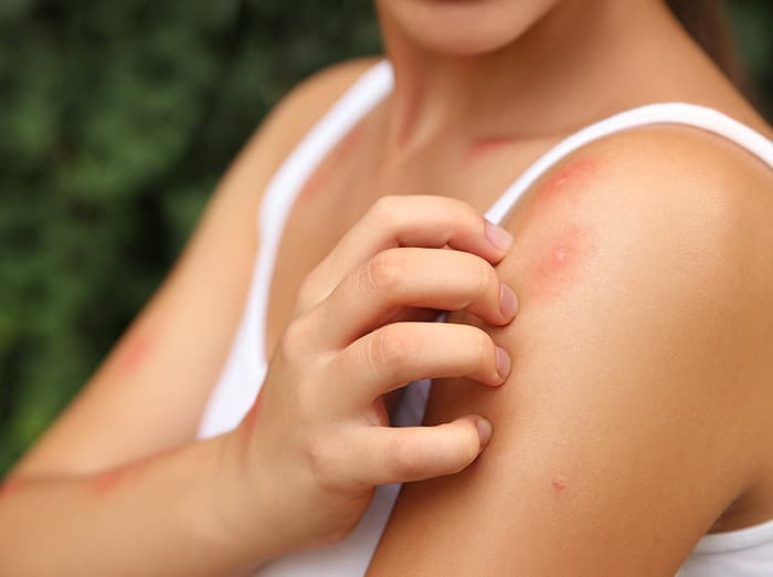 albuquerque resident scratching mosquito bites