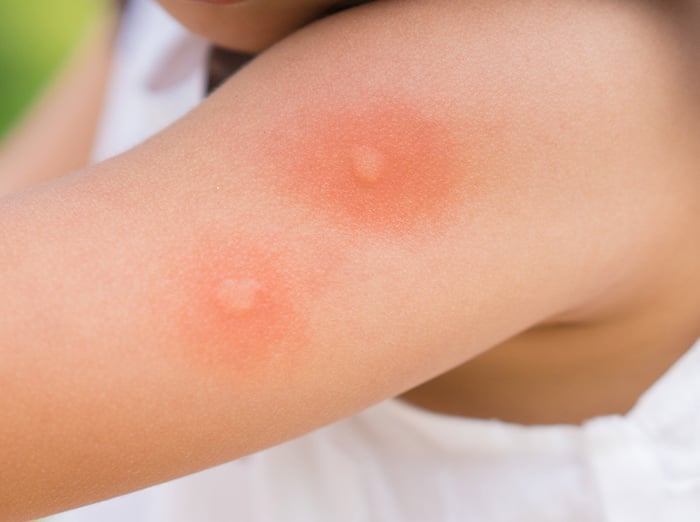 mosquito bites on little girl in des moines