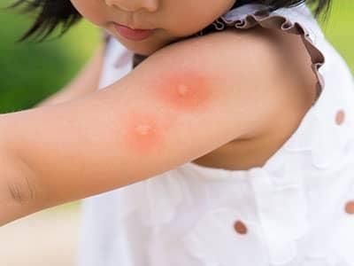 little girl with mosquito bites on arm