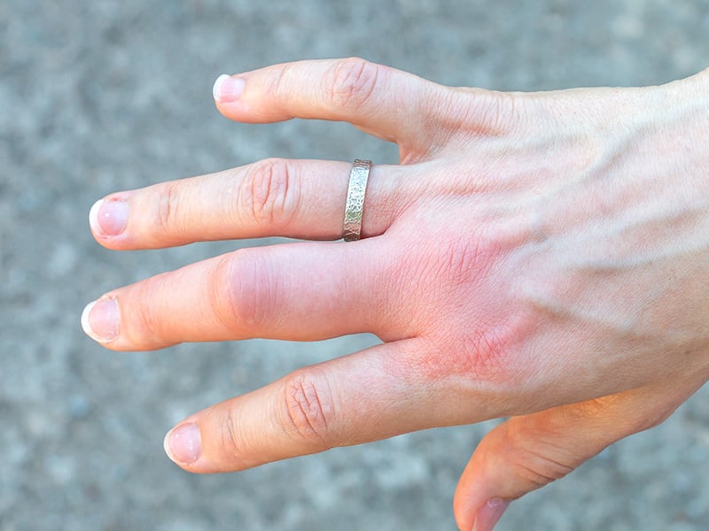 bee sting on hand of richmond resident