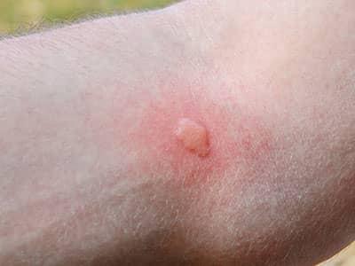 itchy, red mosquito bite on colorado springs resident