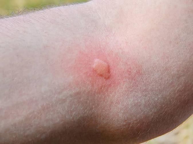 mosquito bite on colorado springs resident