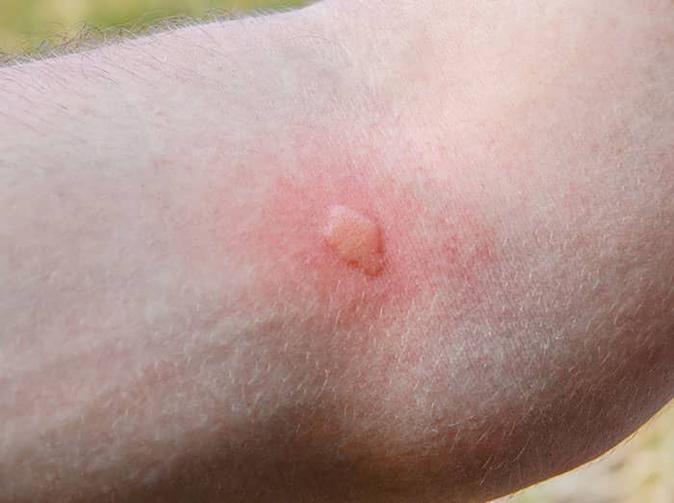 mosquito bite