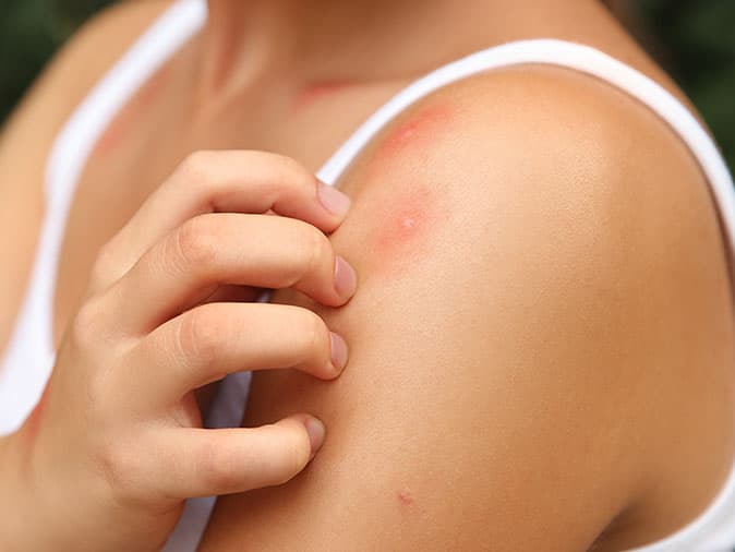 mosquito bite on scranton resident