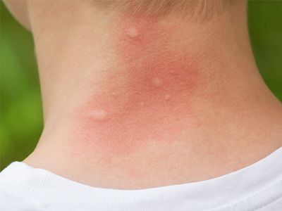 mosquito bites