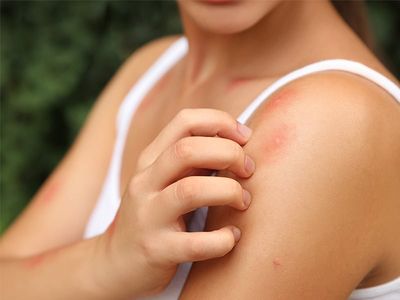 myrtle beach resident covered in mosquito bites