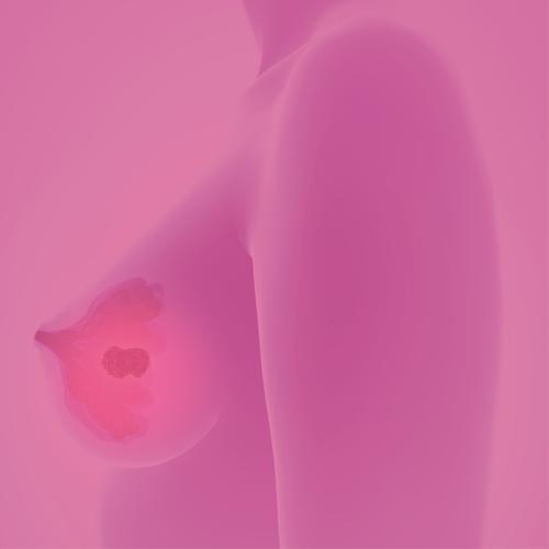 Breast Cancer