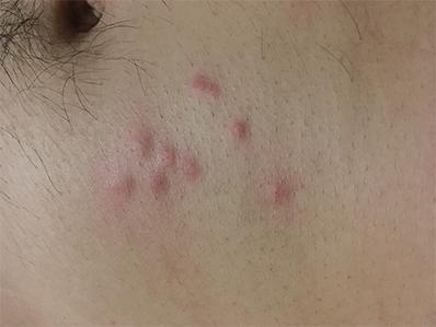 bed bug bites on a new jersey homeowners neck