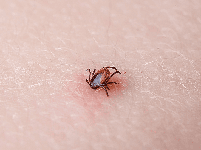 tick embedded under nj resident's skin