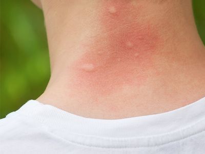 mosquito bites
